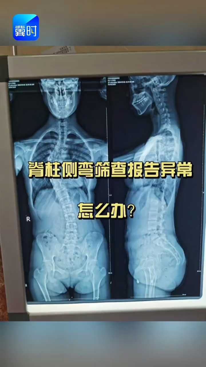 脊柱侧弯筛查报告单异常，家长该怎么办？ #脊柱侧弯 #孩子健康